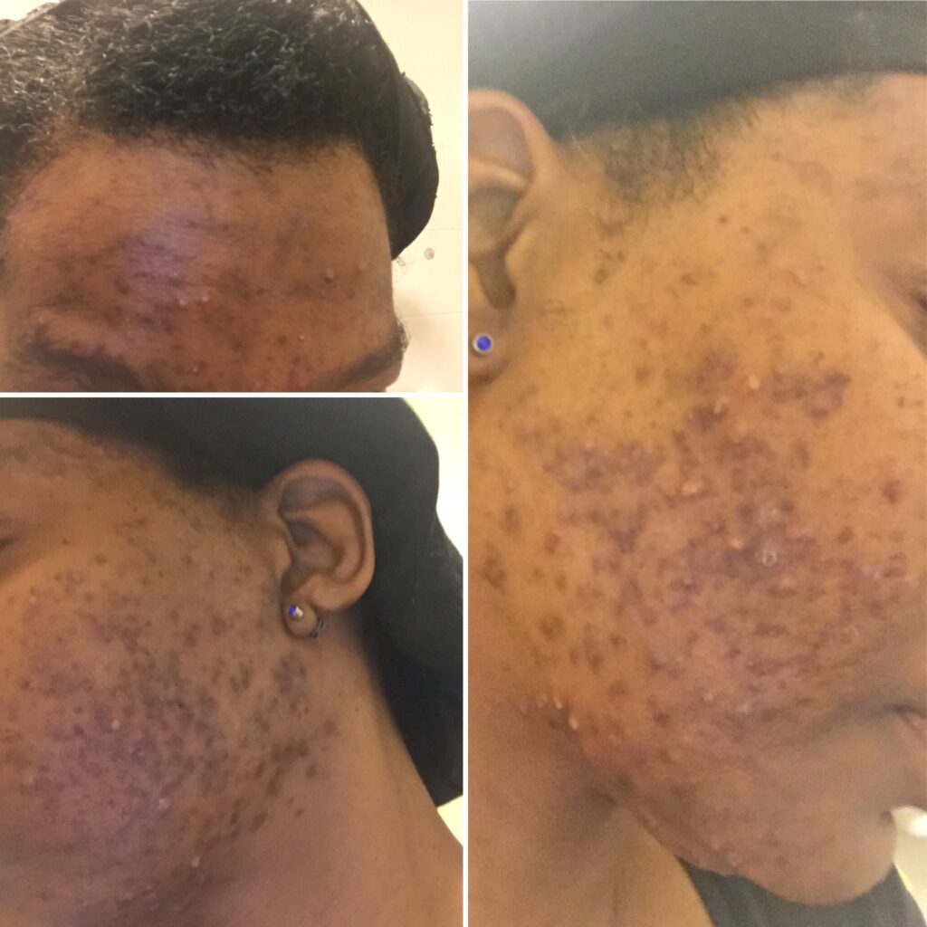 Black woman Face covered in hyperpigmentation  from acne stage 1