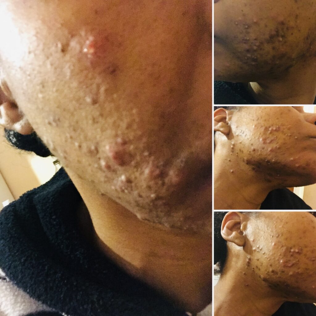 Black woman face, skin broke out in acne stage 1
