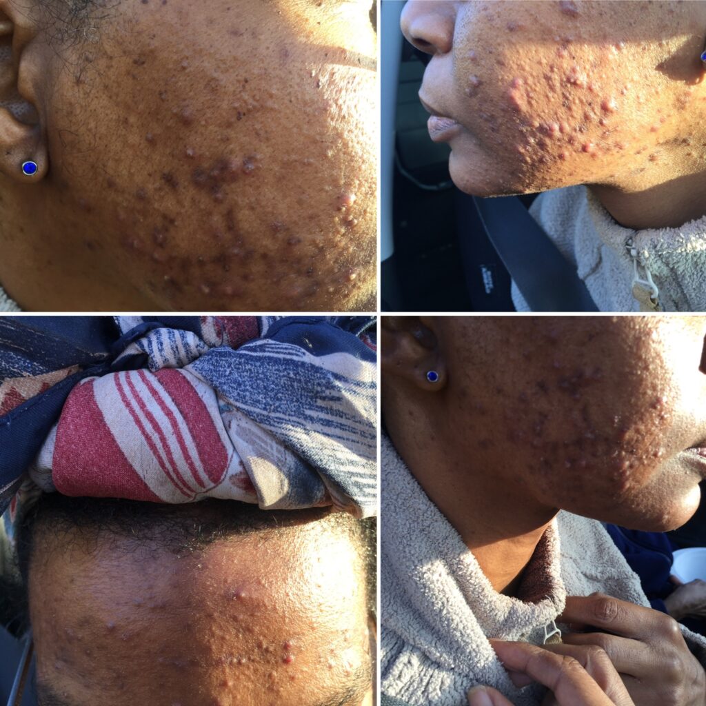Black woman face, skin broke out in acne stage 2