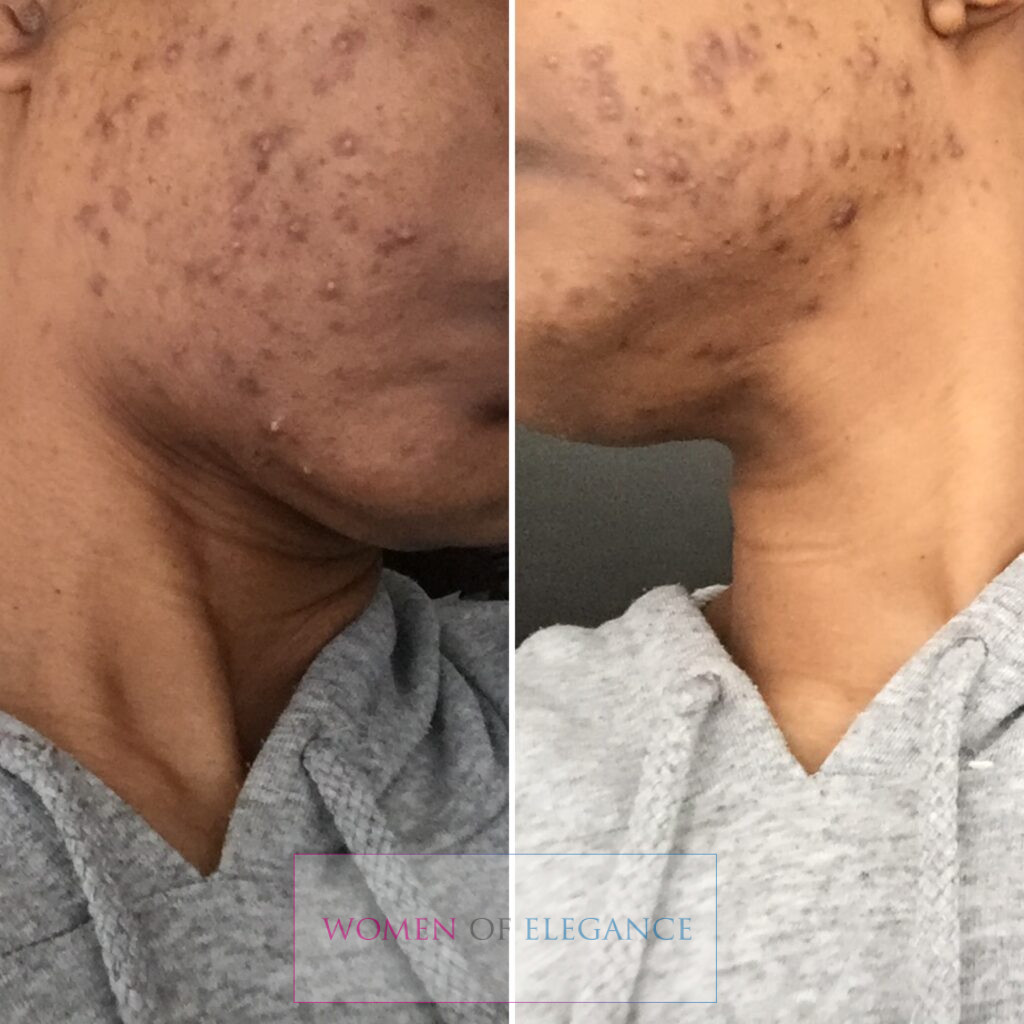 Black woman Face hyperpigmentation started to fade stage 2
